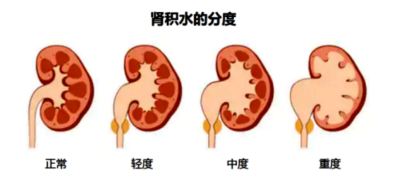 新生儿科携手小儿泌尿外科等多学科团队成功救治重度肾积水宝宝